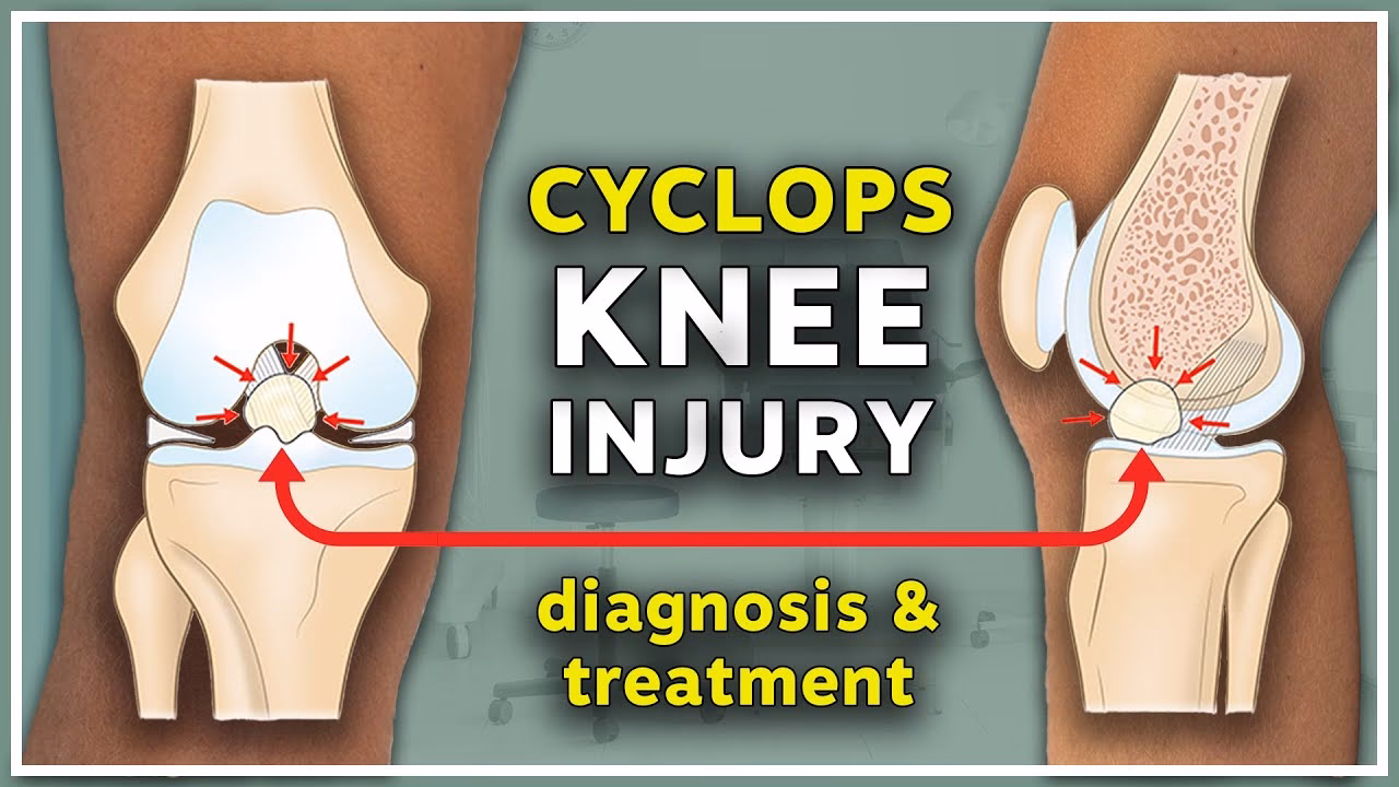 What is Cyclops Medtech postura?