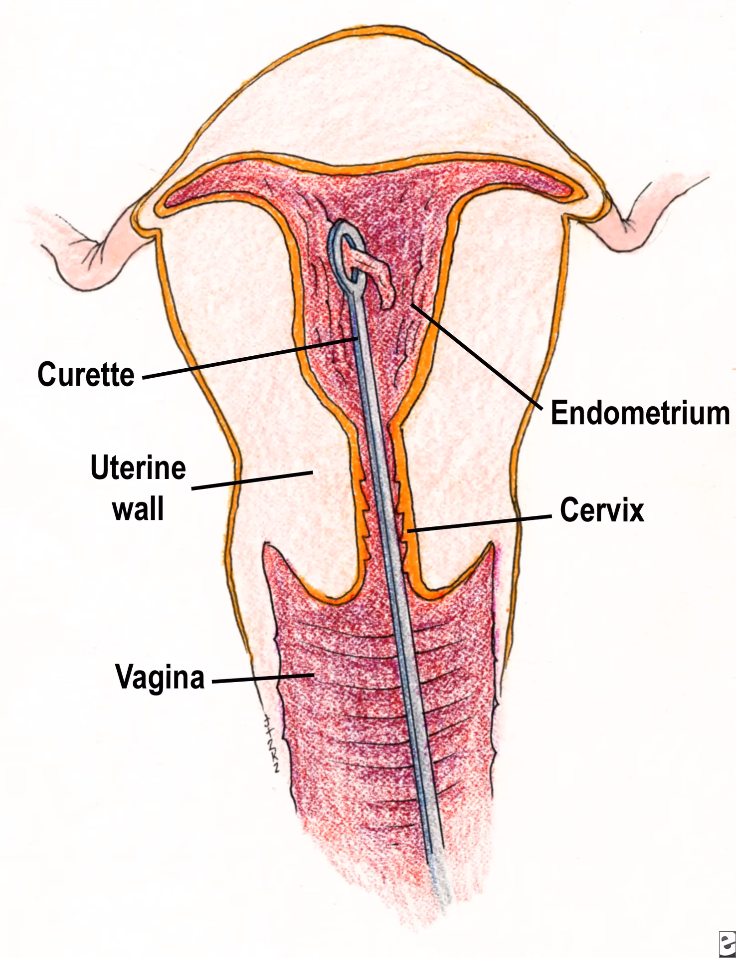Can a D&C cause scar tissue in the uterus?