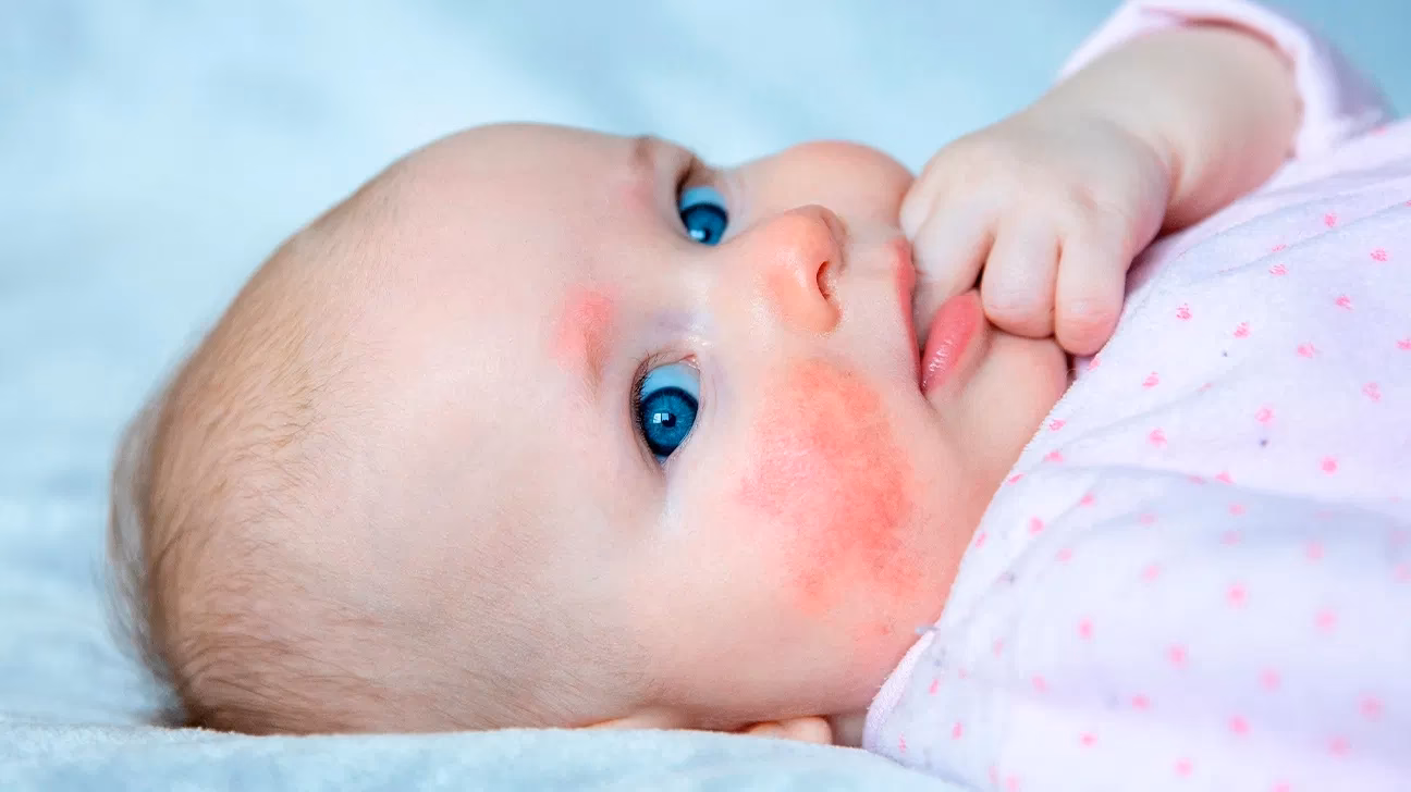 What is a dairy or milk allergy?