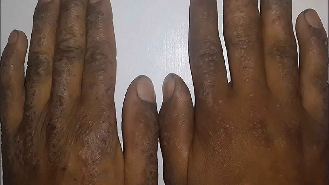 Can eczema and psoriasis cause hand rashes?