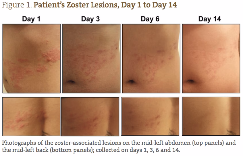 How long does it take for a rash to heal?