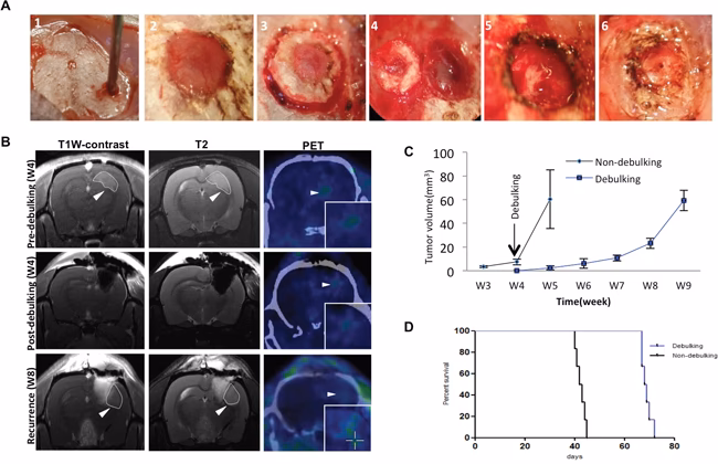 What is debulking a tumour?