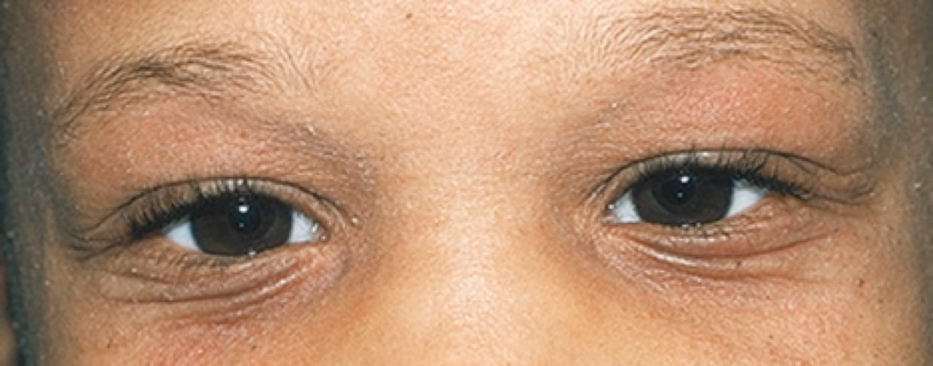 What is a Dennie-Morgan fold?