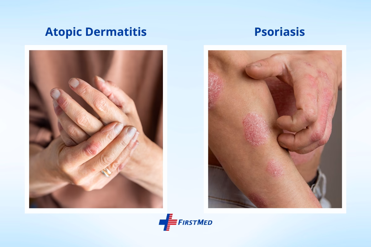 What is the difference between atopic dermatitis and plaque psoriasis?