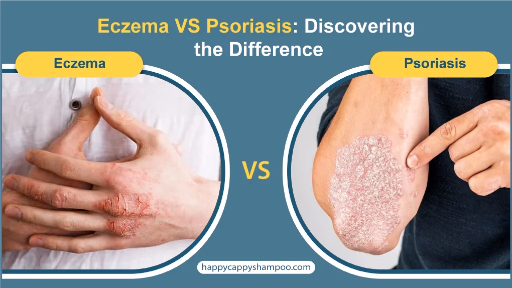 Is atopic dermatitis more common than psoriasis?