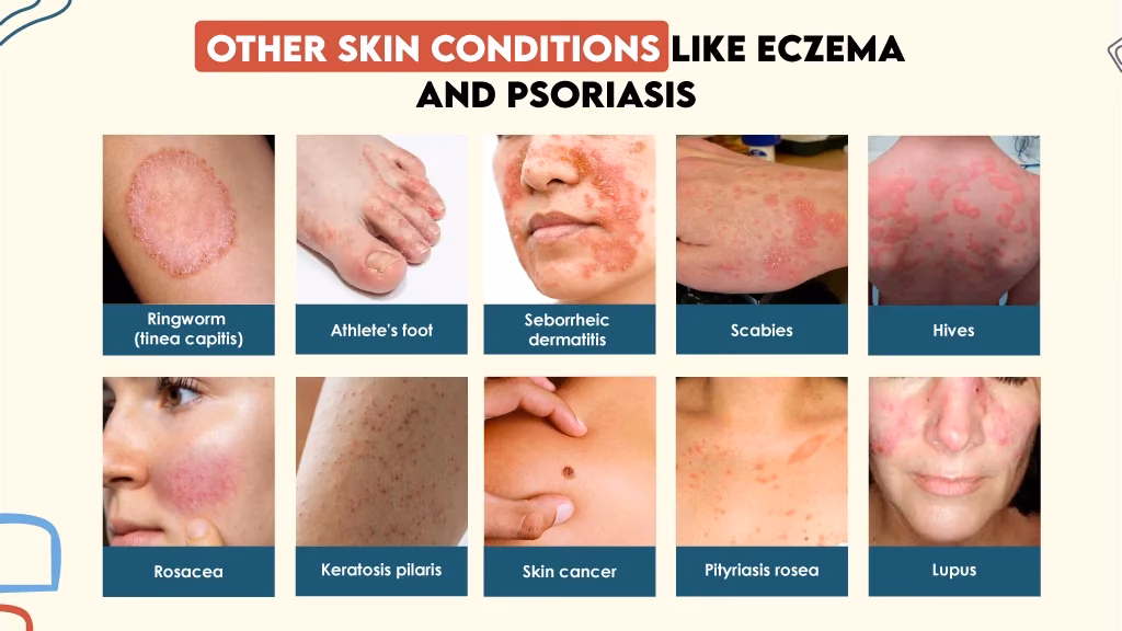 What is the difference between psoriasis and P dermatitis?