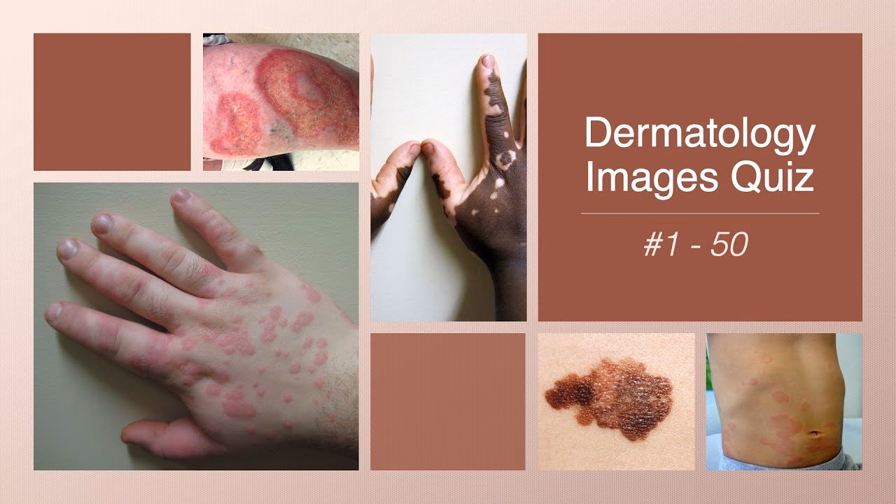 How is atopic dermatitis diagnosed?