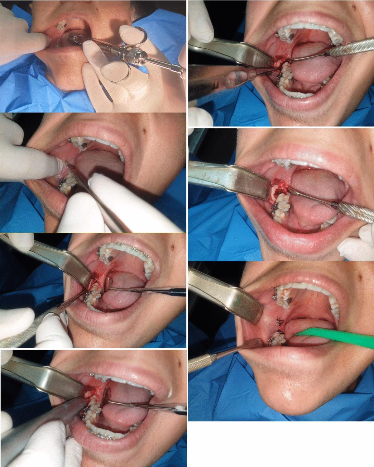 Which surgical specialities use the most dexamethasone?