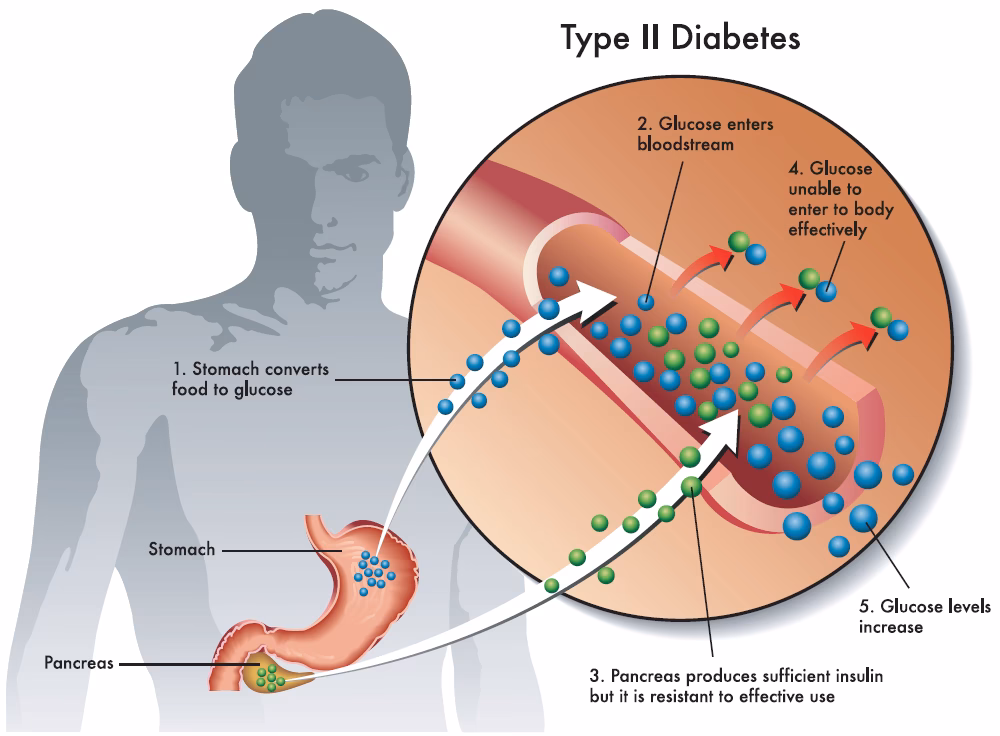 ¿Cuál es la cura para la diabetes?