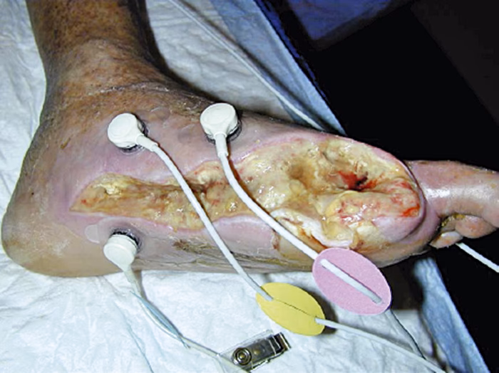 Hvordan behandles diabetes?