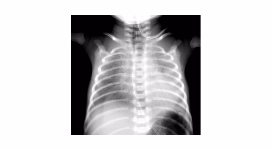 What to look for on diabetic foot plain X-ray?