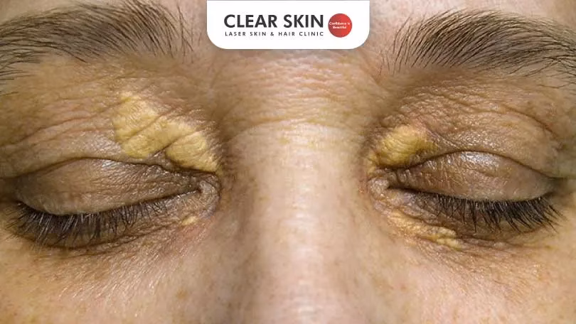 What is xanthelasma palpebrarum?