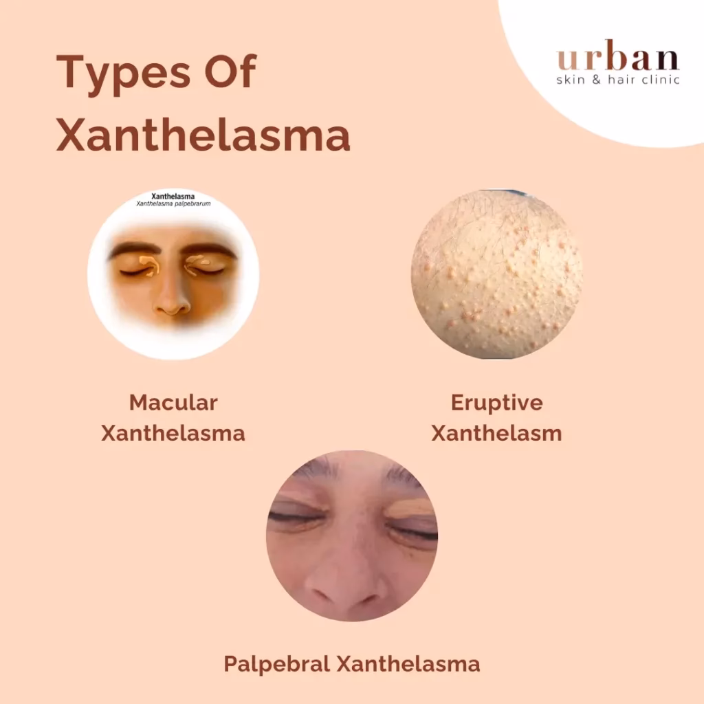 What causes xanthelasma?