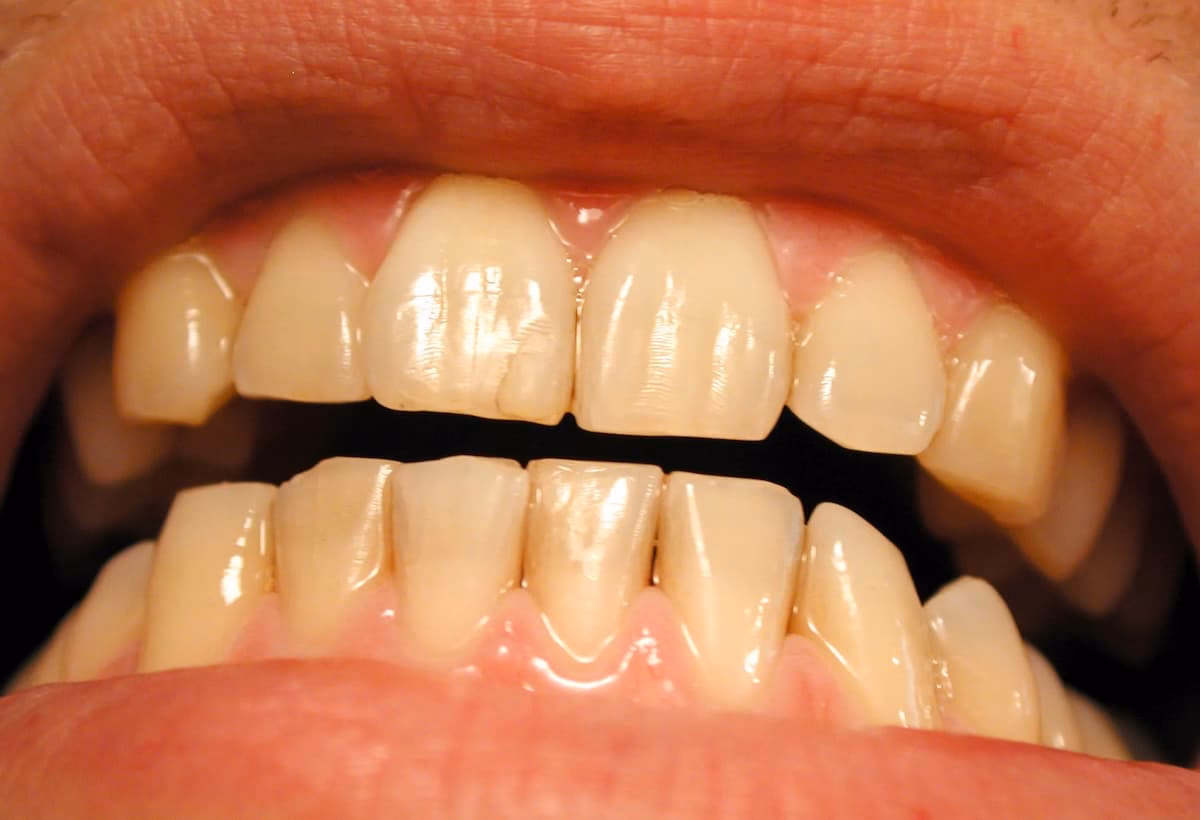 Can diabetes cause tooth decay?