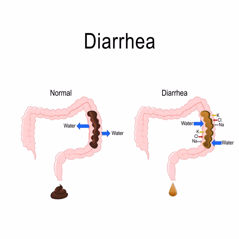 What causes diarrhea?