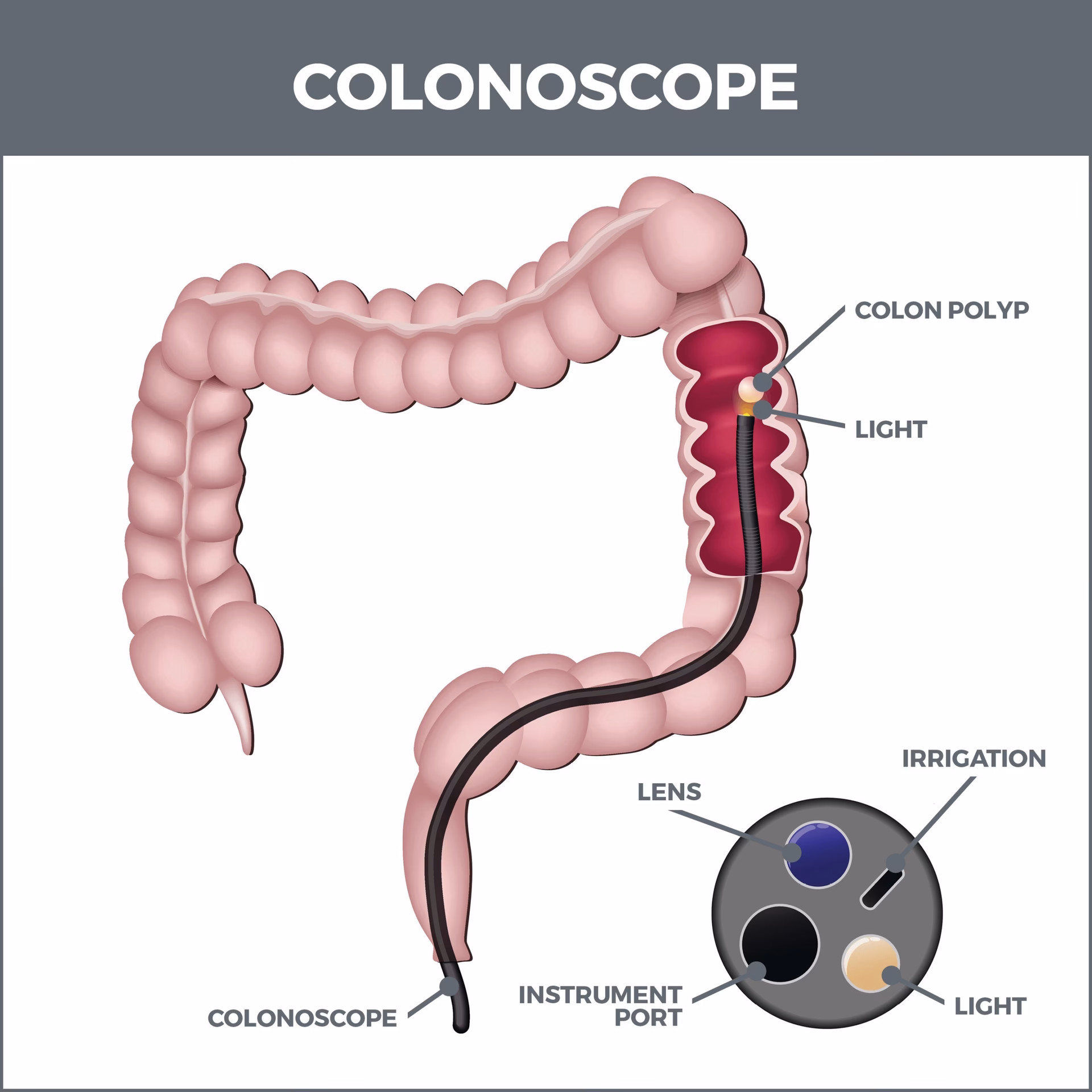 Is diarrhea after a colonoscopy normal?