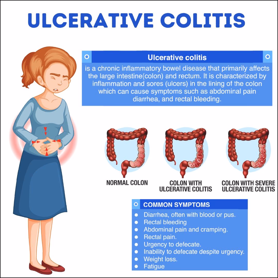 What are the symptoms of infectious colitis?