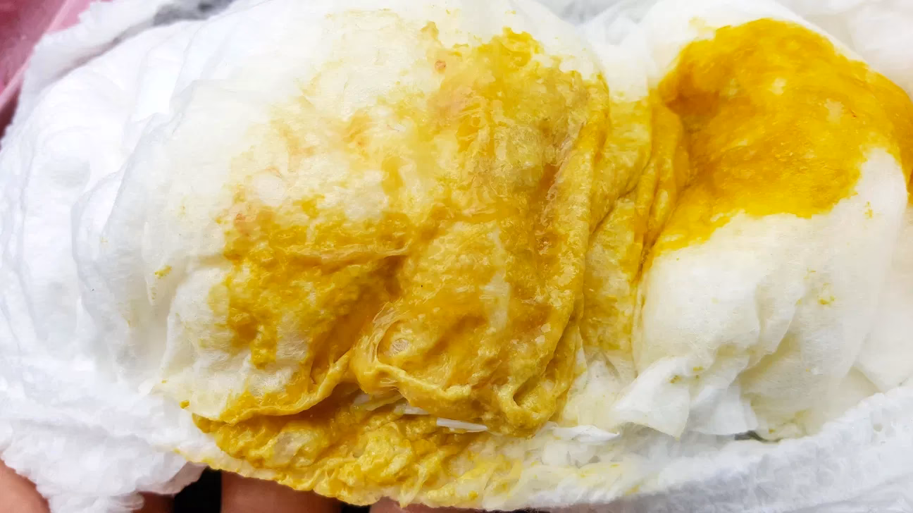 What does mucus in diarrhea mean?