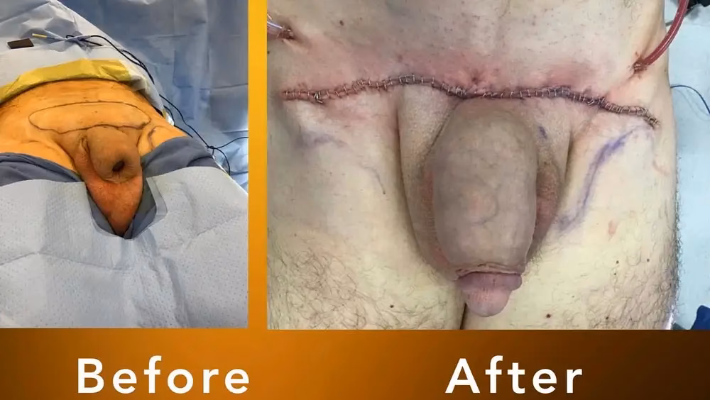 What happens after a genital excision?