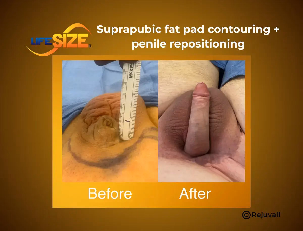 What happens after a genital excision?