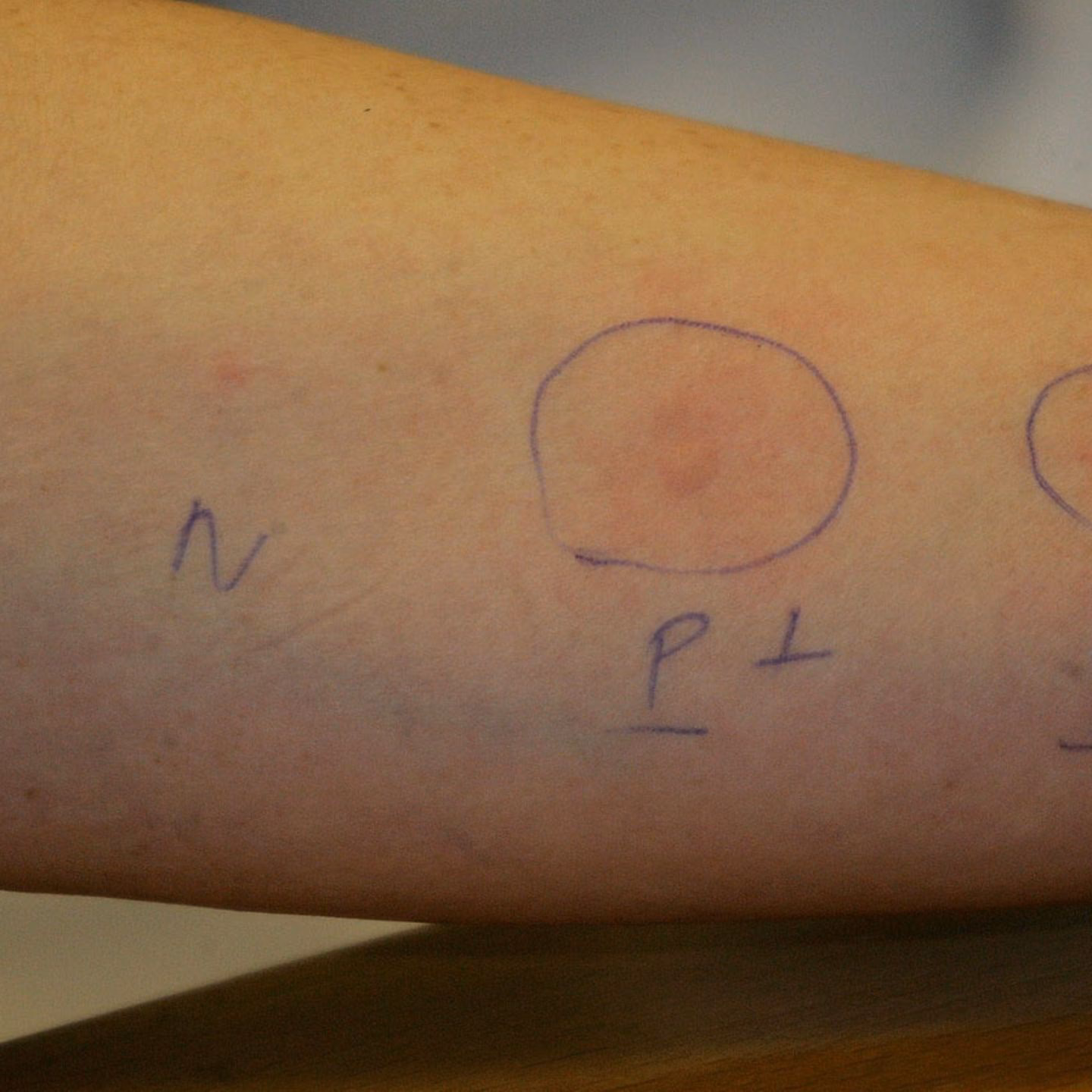 Was ist ein positiver Allergietest?