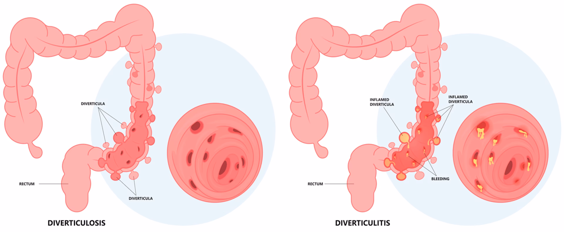Was tun bei Divertikulitis?