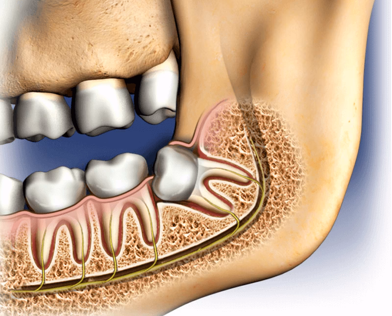 Should I get my wisdom teeth removed without general anesthesia?