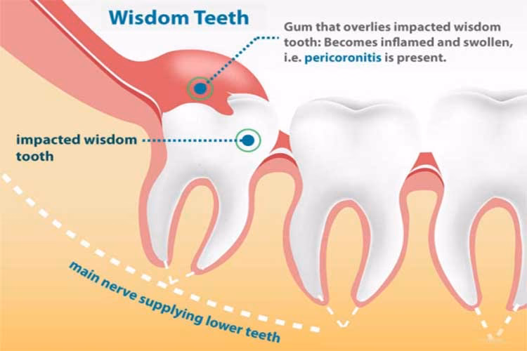 Should I get my wisdom teeth removed without general anesthesia?