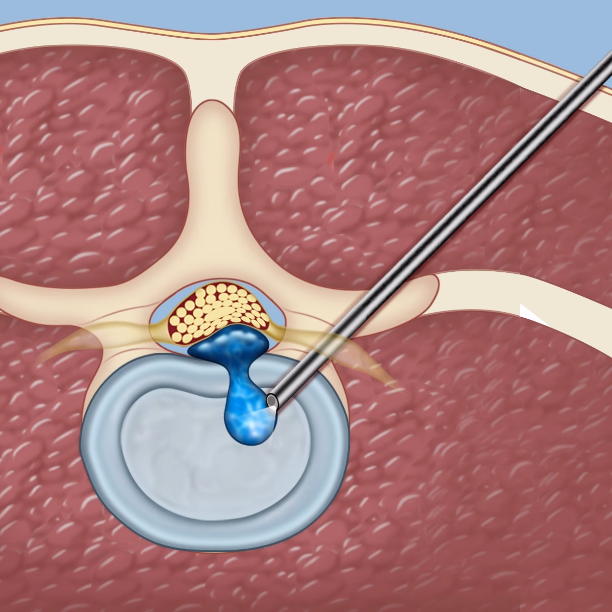 Is herniated disk surgery safe?