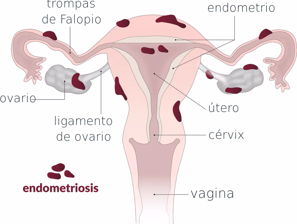 ¿Cuáles son las complicaciones de la endometriosis?
