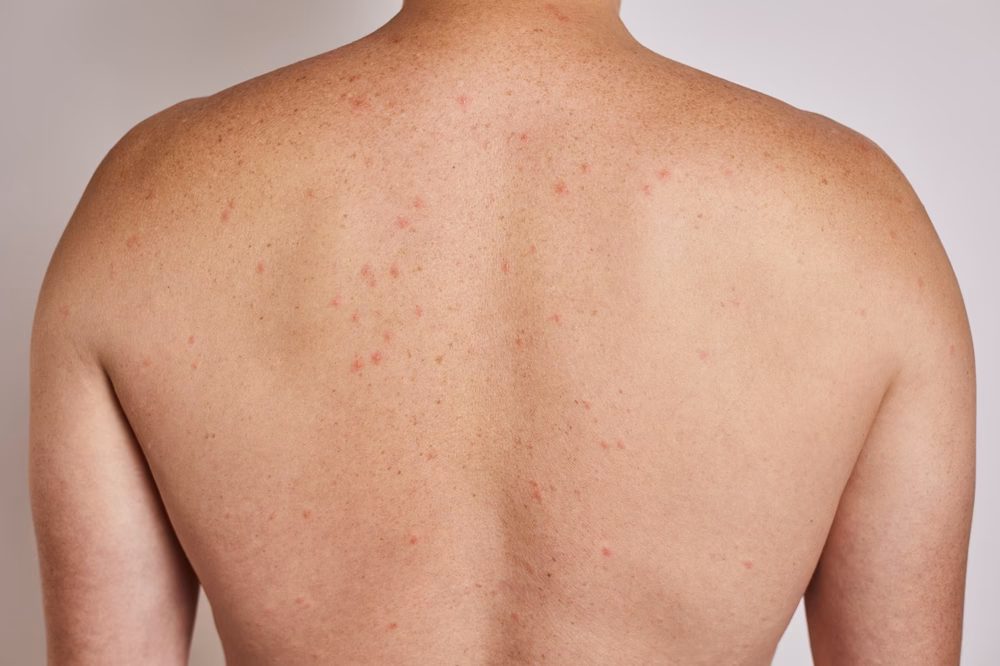 What is a drug allergy rash?