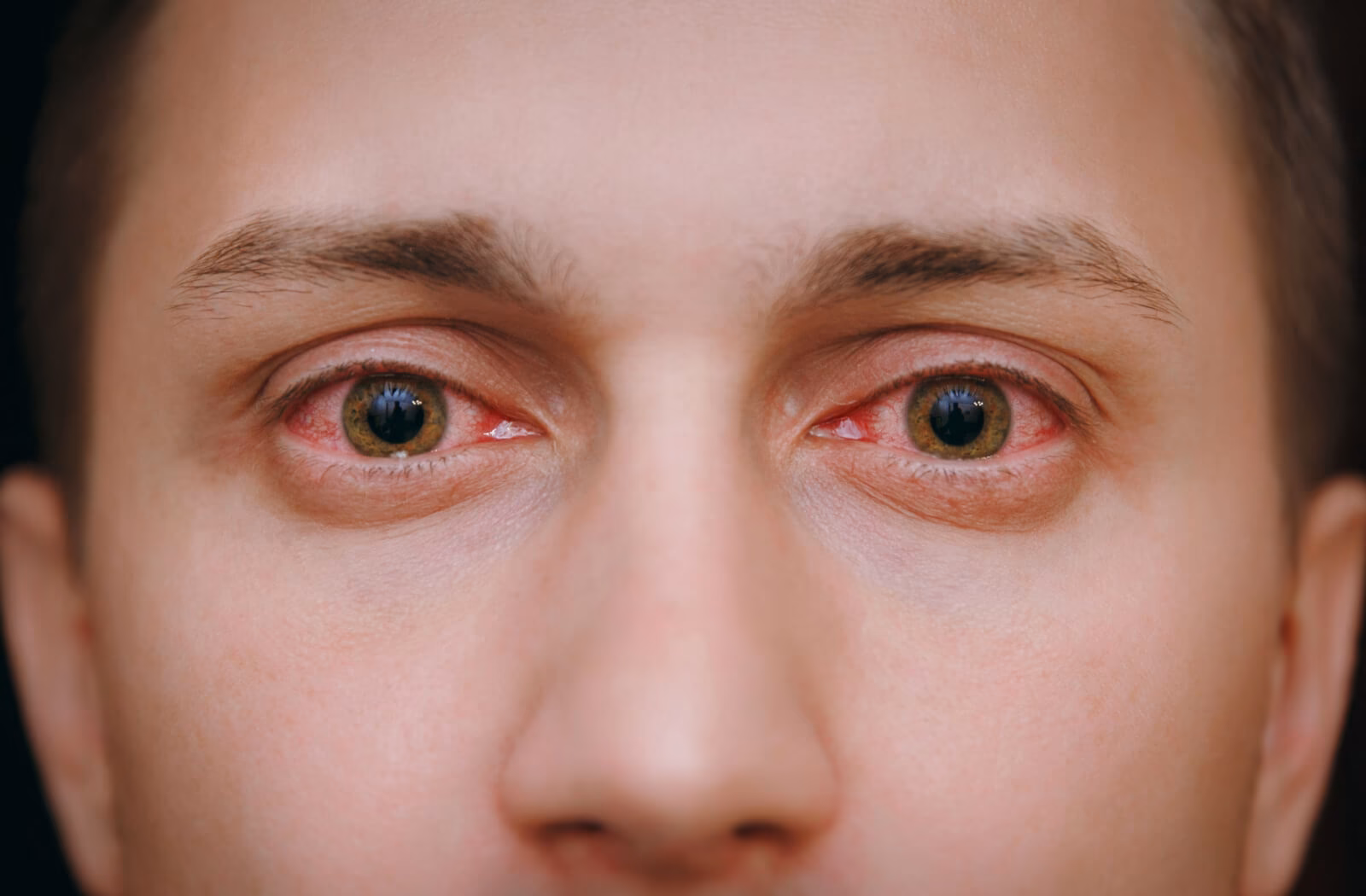 What are the symptoms of dry eyes?