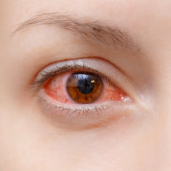 How can you tell between allergies and dry eyes?