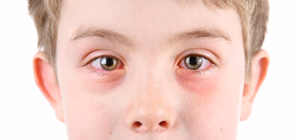 Does dry eye cause burning?