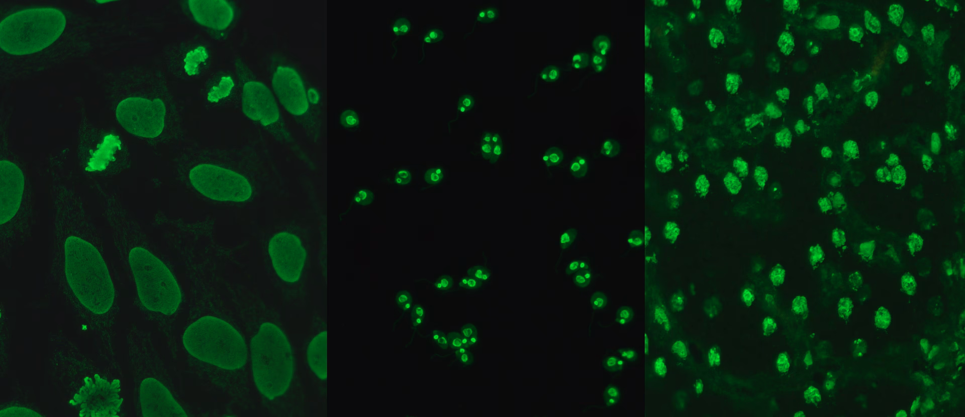 Which HLA-markers are associated with SLE and anti-dsDNA?
