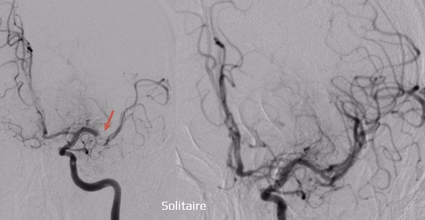 What is contrast angiography (DSA)?