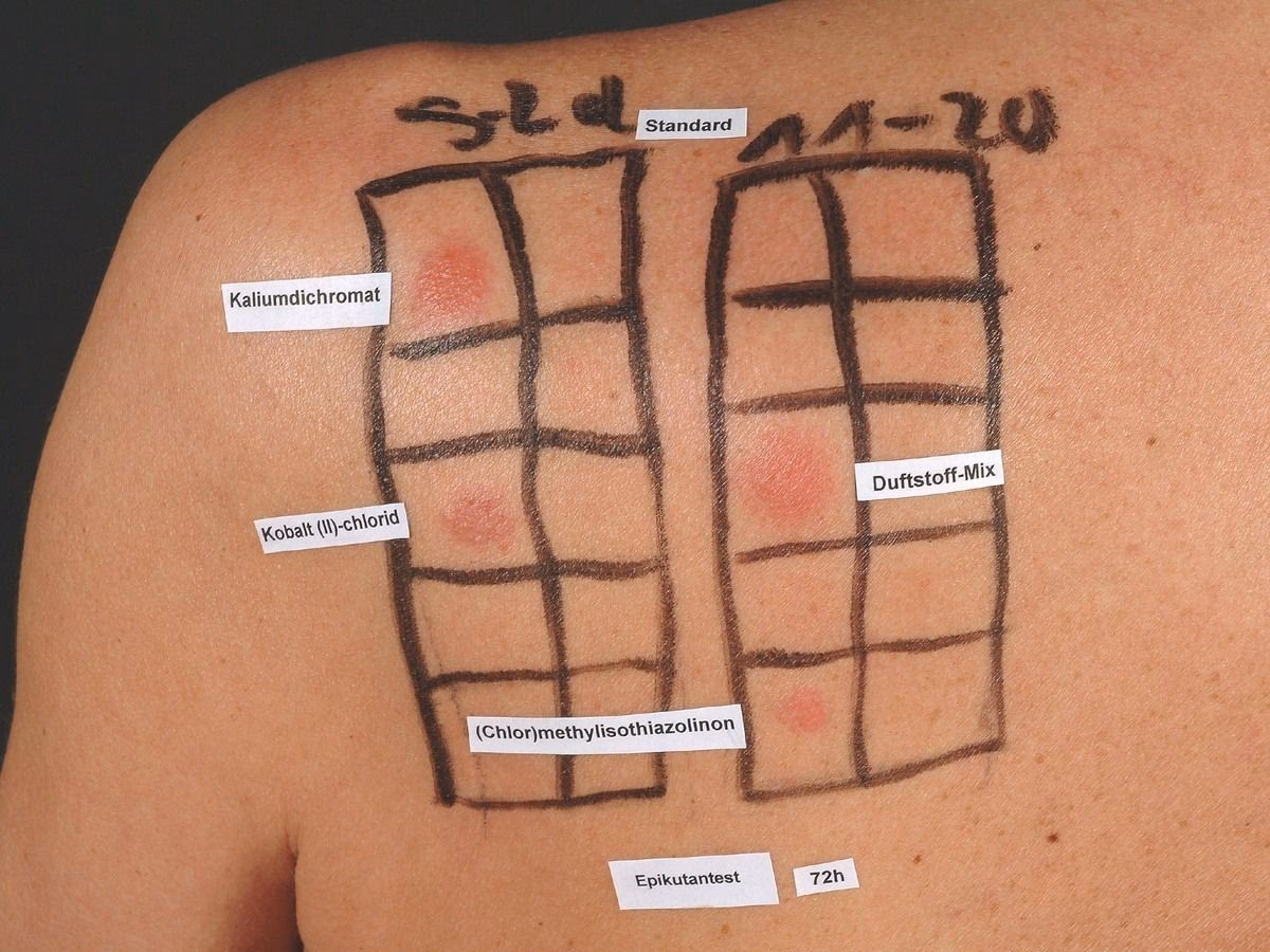 Wie viel Prozent der Bevölkerung leiden unter einer Allergie gegen Duftstoffe?