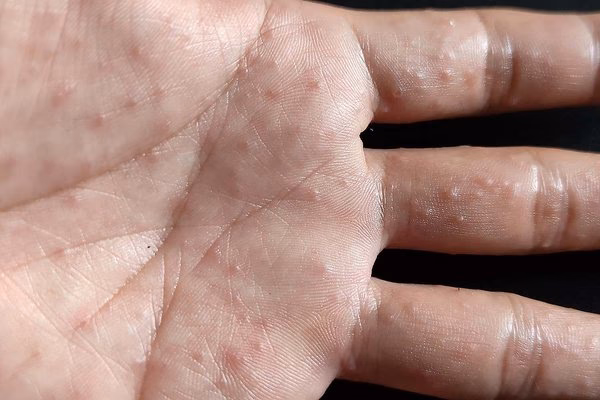 What does dyshidrotic eczema look like?