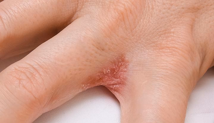 Can dyshidrotic eczema be cured?