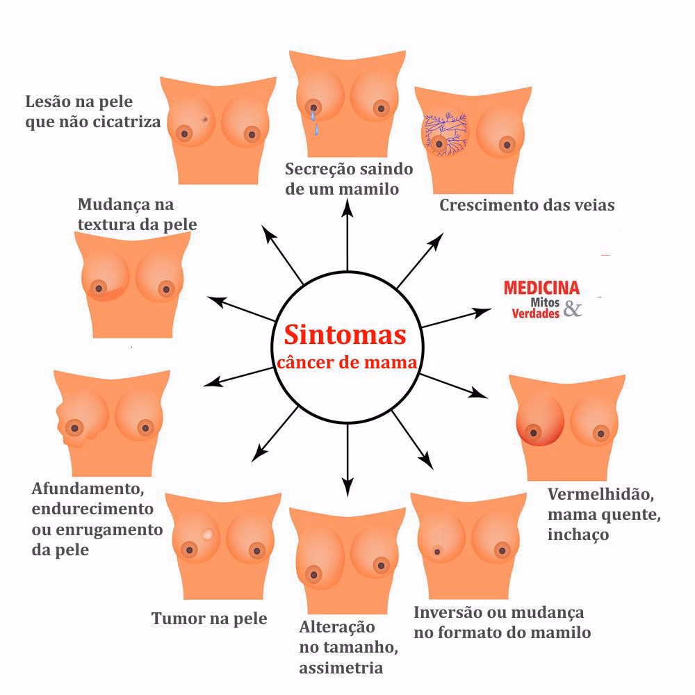 Qual a chance de cura do câncer de mama?