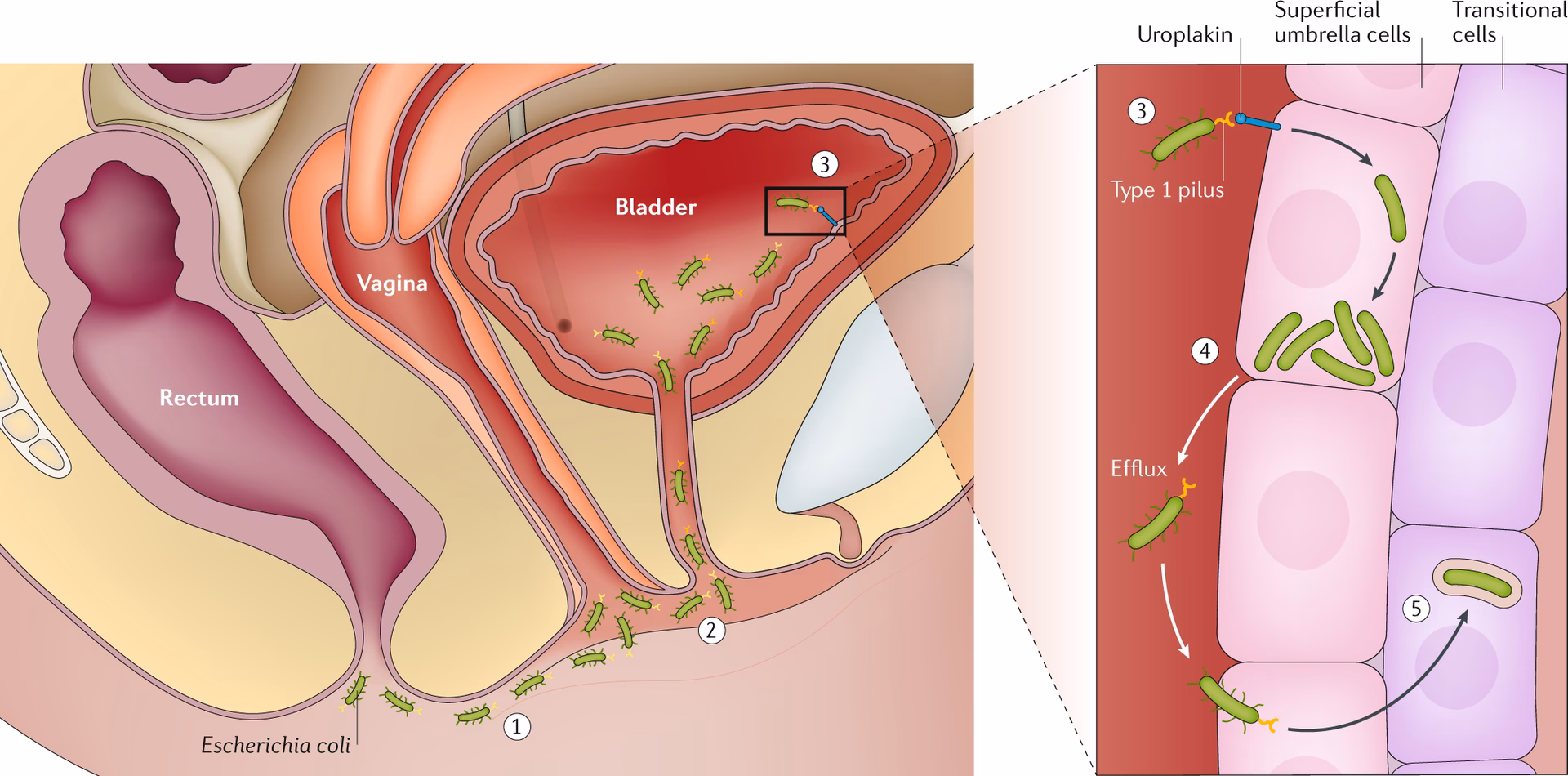 Can E coli protect patients from Utis?
