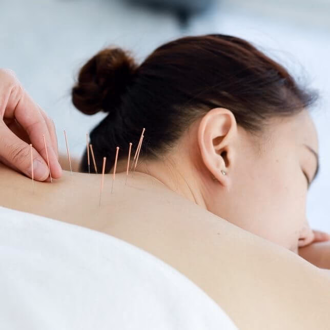 What is traditional Eastern acupuncture?