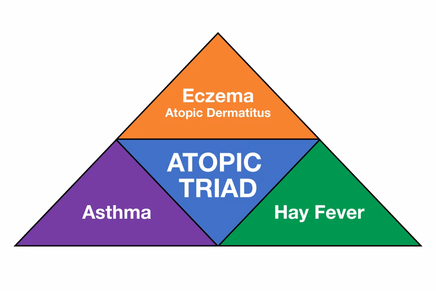 Can food allergy cause eczema?