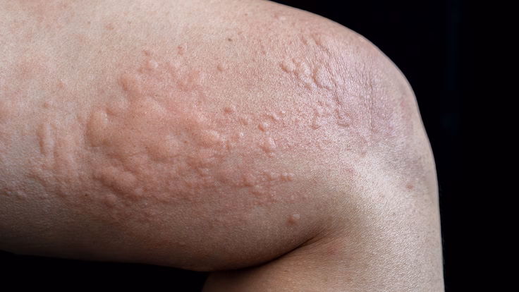 Was sind die Symptome einer Eichenprozessionsspinner-Allergie?