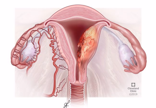 What is endometrial cancer?