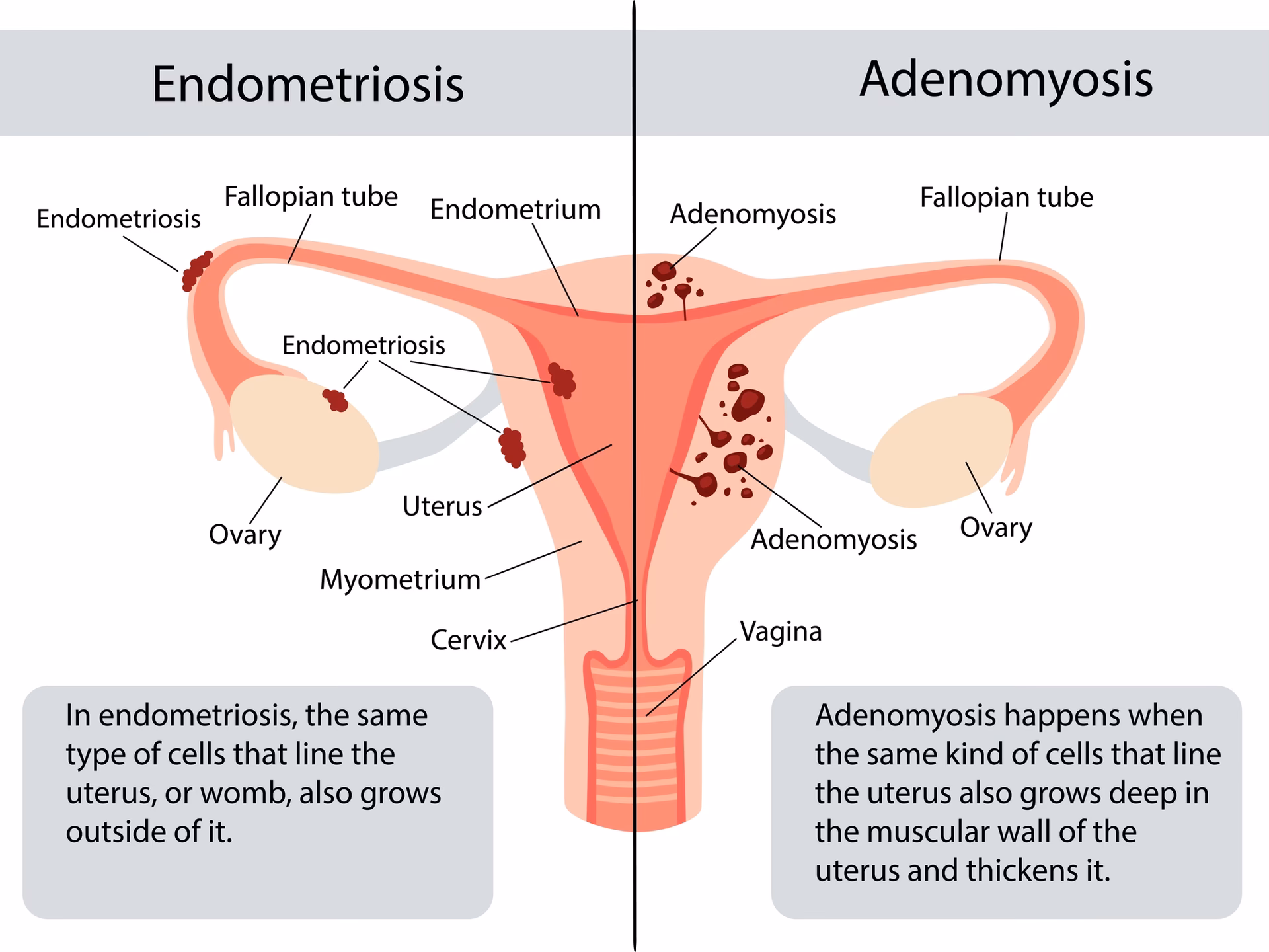 What is the plural of endometrioma?