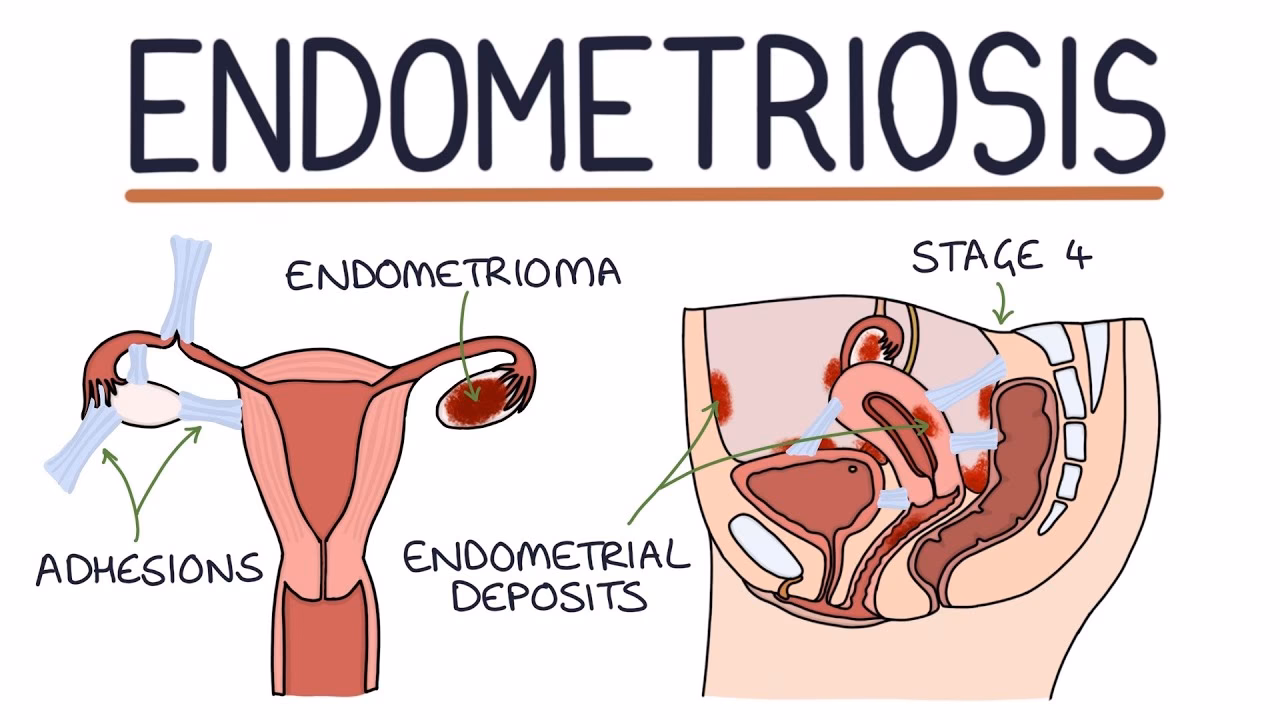What is endometriosis & how is it treated?