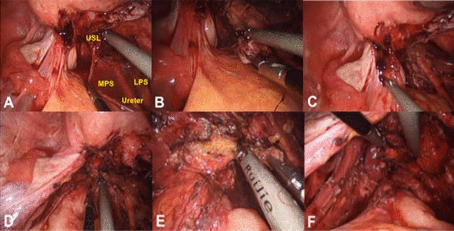 Does surgery improve Endometriosis recurrence?