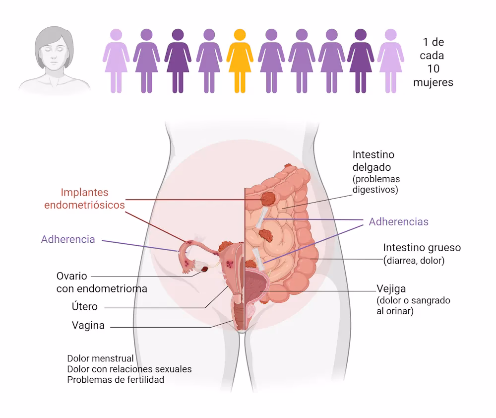 ¿Cómo se diagnostica la endometriosis?