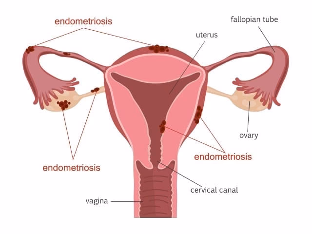 How can Endometriosis UK improve diagnosis times?
